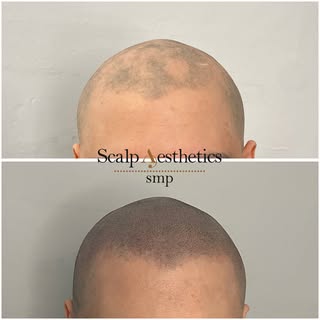 ✨ Fresh Scalp Micropigmentation Result ✨
This amazing transformation was done to camouflage alopecia