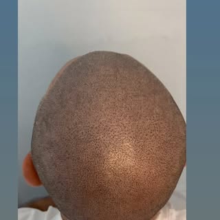 Scalp micropigmentation is all about precision and patience 💫
We build up the density session by se