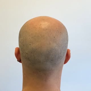 A fresh SMP transformation ✨

A natural-looking result designed to restore the appearance of density