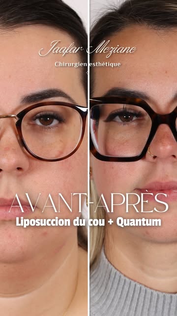 Transformation sans cicatrice 

Liposuccion ciblée du cou, associée à la technologie Quantum, le MQ 