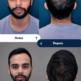 Seis meses depois do transplante,  50 a 60% do resultado final, o Murilo voltou para contar como foi