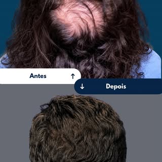 Uma semaninha de pós e você já consegue, rapidinho, voltar para a sua rotina.

No depoimento, o Odil