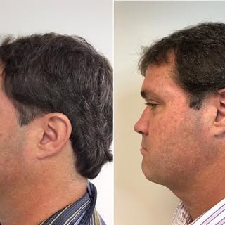 Utilizing AGNES RF technology, a micro-insulated needle penetrates the skin and eliminates fat depos