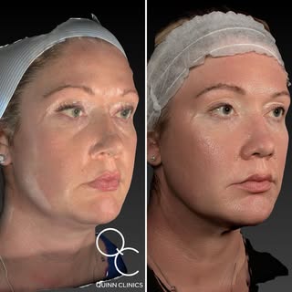 2015 ➜ Now
10 year journey👀

A little anti-ageing injectables, obviously some laser for skin rejuve