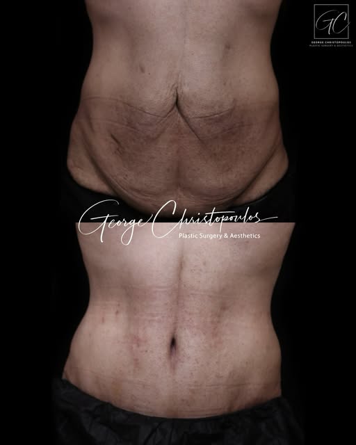 Abdominoplasty | Before & After

This patient presented with significant lower abdominal skin laxity