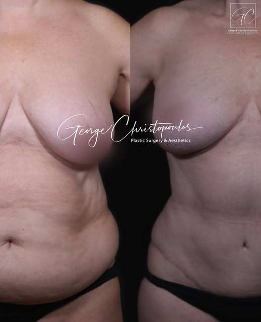 Mastopexy & Abdominoplasty | Before & After

This patient presented with loss of upper-pole fullness