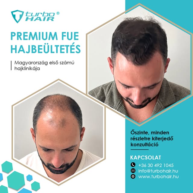 ✨ Mennyit számít egy természetes, szépen kialakított hajkorona?

Egy jól megtervezett hajbeültetés n