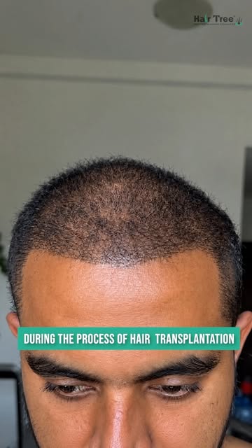 A journey from where it started to where it is today. 
See the visible changes following a hair tran