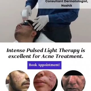 Struggling with persistent acne, redness, or rosacea?
Intense Pulsed Light (IPL) therapy helps reduc
