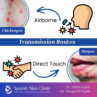 Chickenpox and Herpes may look similar on the skin, but their transmission and treatment are differe