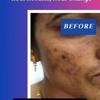 Before ➡️ After
The results speak louder than words.

Acne Scar treatment done right, with visible i