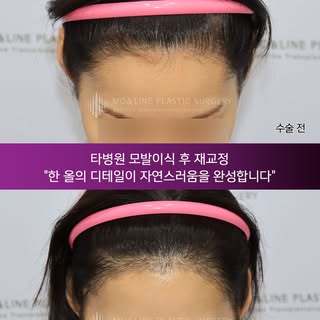 -
"2주차에도 자연스러운 모류의 흐름"

타병원 모발이식 후
헤어라인 재교정을 진행한 사례입니다.

모발이식의 자연스러움은
단순히 얼마나 많이 심느냐보다
"한 올 한 올의 방향과