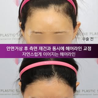 -
안면거상 후, 구렛나루가 짧아지고 측면 헤어라인이 넓어 보이시나요?

안면거상 후에는 헤어라인의 위치와 형태가 달라지면서
얼굴이 이전보다 길거나 넓어 보일 수 있습니다.

이럴