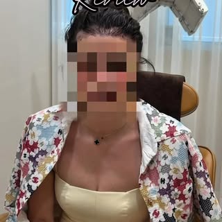 -
[ 모발은 채워졌지만,
원하는 헤어라인은 아니었습니다.
10년 동안 고민했던 여성 헤어라인 재수술]

튀르키예에서 첫 모발이식을 받은 후에도
직선적이고 각진 헤어라인과 자연스럽