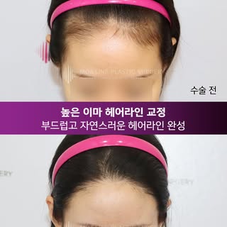 -
높은 이마 헤어라인 교정,
부드럽고 자연스러운 헤어라인 완성.

기존 모발의 방향과 흐름을 고려해
자연스럽게 이어지는 헤어라인을 디자인합니다.

시간이 지나도 자연스럽게 어우러