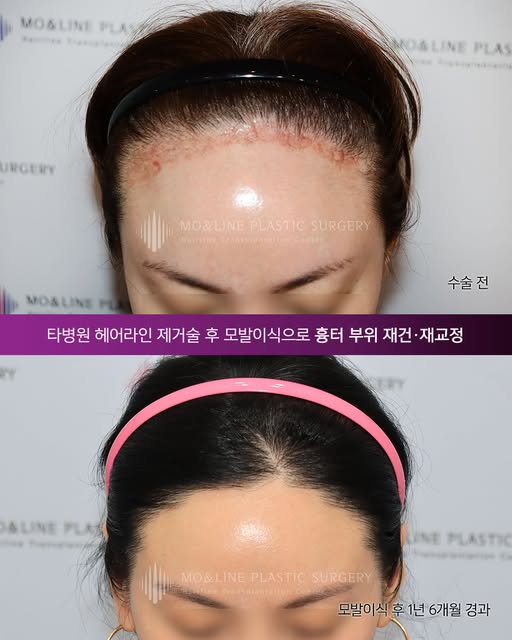 -
[헤어라인 제거술 후 남은 흉터 부위,
모발이식으로 다시 자연스럽게 재건할 수 있을까요?]

타병원에서 헤어라인 제거술 후 약 1개월만에
흉터와 반흔이 남아 있는 상태에서 진행