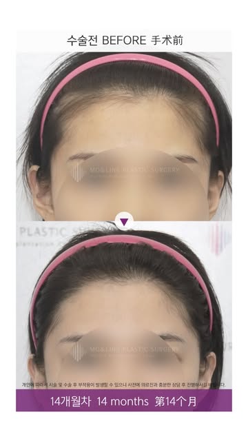 -
M자 이마가 고민이었던 여성 환자분의
헤어라인교정 후 1년 2개월 경과입니다.

얼굴형과 전체적인 비율을 고려해 라인을 디자인하고,
잔머리까지 자연스럽게 이어지도록 섬세하게 교