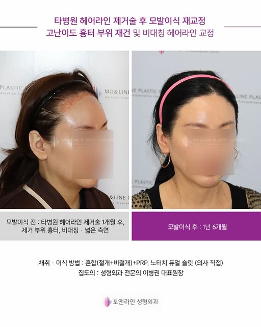 -
재교정의 목표는
단순히 다시 채우는 것이 아닙니다.

타병원에서 헤어라인 제거술을 받은 후,
재교정을 위해 본원에 내원하셨습니다.
제거술 1개월 후 남아 있던 흉터와 반흔을 고