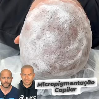 Micropigmentação Capilar