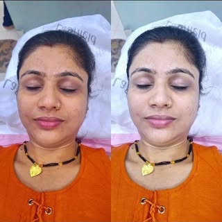 Chemical Peel treatment for skin pigmentation 🥰🥰
Dm : @skin_springcosmeticclinic 

👉Anti Ageing
�