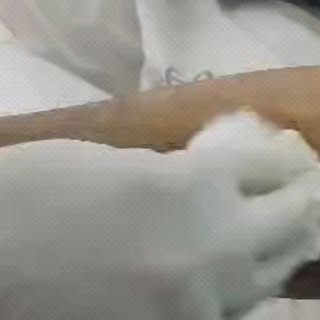 Post Accidental Scar Treatment by Micro Needling Procedure.
.
.
.
.
Book an Appointment now- 7019487