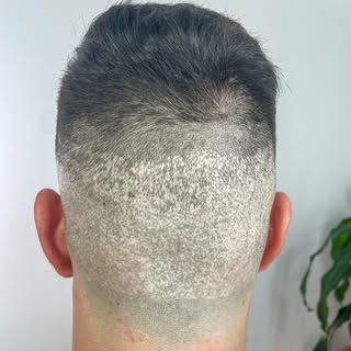 Este es un ejemplo de la cicatriz producida por la extracción del folículo de cabello para un traspl