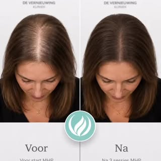 ✨ Dunner wordend haar? Je bent niet alleen.

Met Micro Haar Pigmentatie (MHP) creëren we optisch mee