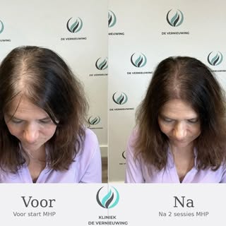 ✨ Resultaat na 2 MHP-sessies! ✨

Wat een mooi verschil al zichtbaar na slechts 2 behandelingen. De h