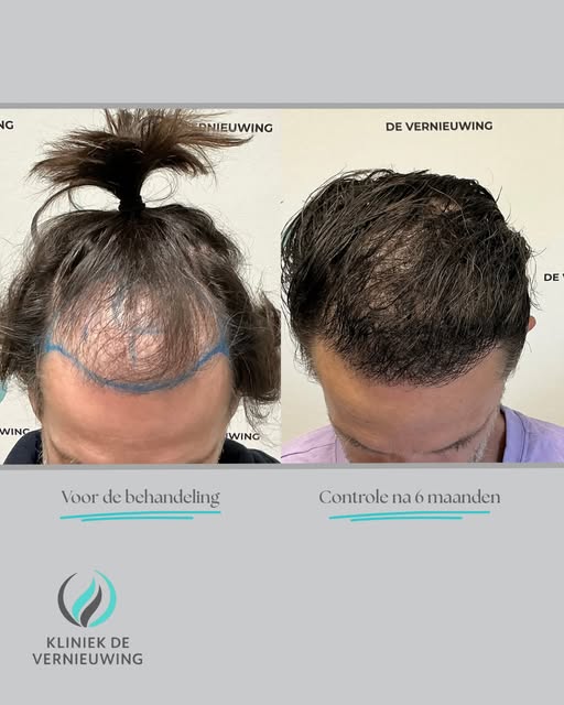 Wat vind jij van dit resultaat?

Een prachtig resultaat al na 6 maanden!✨⏳🔥
Een vollere haardos en 