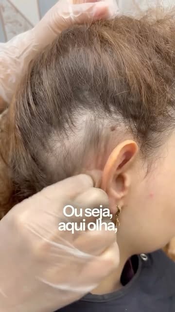 A queda de cabelo e o afinamento têm causa e tratamento, e o primeiro passo é entender o que o seu c