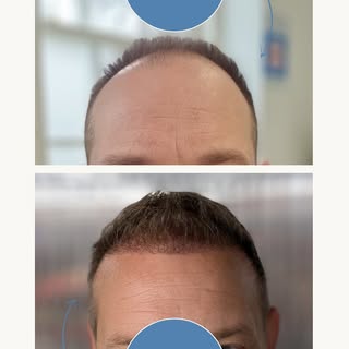 Experiencing hair loss? A hair transplant could be your permanent solution. With a 98% success rate,