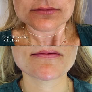 Chin Filler for Chin With a Dent: How It Can Smooth Out Imperfections 💉

Chin filler has become a w