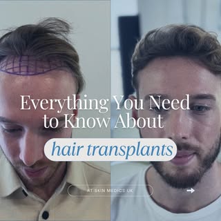 Struggling with hair loss and looking for real answers? We understand — hair loss can feel confusing