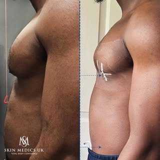 Discover how gynecomastia surgery can help flatten your chest and create a more defined, sculpted lo