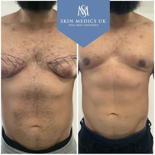 At Skin Medics UK, we specialise in treating gynecomastia to help you achieve a flatter chest, reduc