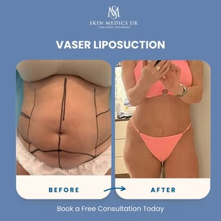 Get Summer-Ready Now! 🌊⛱️
VASER Lipo – Now Only £1,999

This is your sign to sculpt your body and s