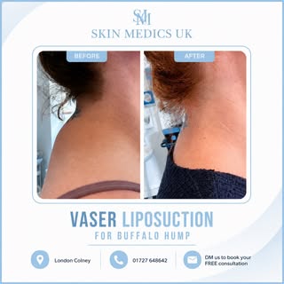 ✨ Buffalo Hump Vaser Liposuction – Reveal a Smoother, More Defined Neck & Upper Back ✨

Say goodbye 
