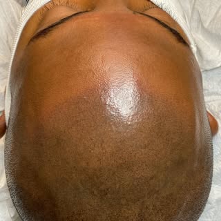 Soft hairline to go with this SMP overhaul on top of previous botched work. 
••
✔️Free consultations