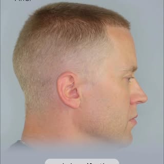 Rated the #1 FUE Hair Transplant Clinic in the USA by Hairsite.com