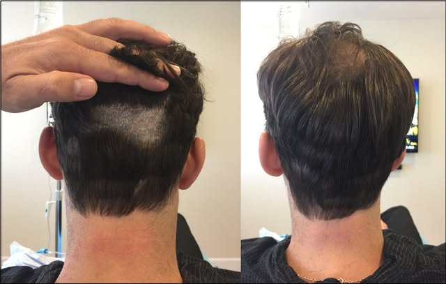 No Shave FUE - At Alvi Armani, we understand that discretion, presentation, and precision are essent