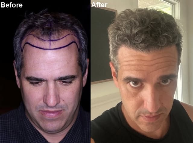 Alvi Armani hair restoration - New Dr. Barton result out of our Salt Lake City, Utah Clinic restorin