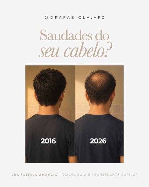 Saudades do seu cabelo? 10 anos fazem diferença — e a calvície não para sozinha.

2016: cabelo cheio