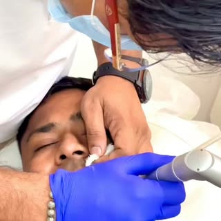 Mole removal is a safe, minor outpatient procedure performed under local anesthesia. Common methods 