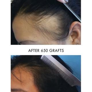 Traction alopecia is one of the most common causes of hairline thinning in women—often caused by yea