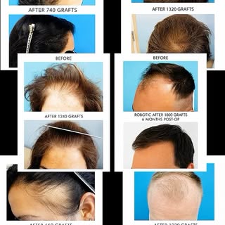Still thinking about a hair transplant? This is your sign. ✨

With thousands of successful hair rest