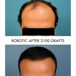 This patient achieved a natural-looking transformation with 2,100 robotic grafts at The Center for H