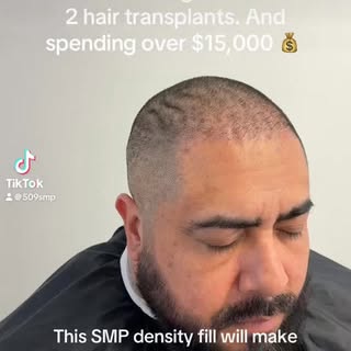 This client drove from over 3 hours away to get his his SMP done after getting 2 hair transplants an