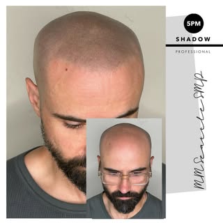 The only hair loss solution that’s  100% effective!

Scalp Micropigmentation Seattle 

Schedule your