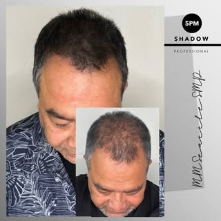 🔥 Still think shaving your head is your only option?

This client wanted the appearance of a fuller