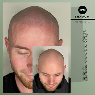The only hair loss solution that’s  100% effective!

Scalp Micropigmentation Seattle 

Schedule your